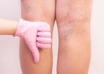 Bagaimana Awal Mula Varises Terjadi?