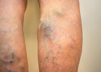 Gejala Varises yang Sering Diabaikan dan Cara Mudah Mengatasinya, Yuk Simak Lebih Lanjut!