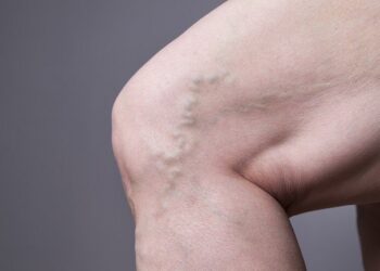 Jenis-jenis Varises dan Penjelasannya