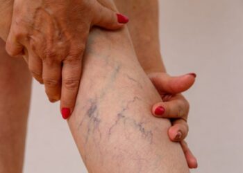 Varises dari Ramuan Kuno Sampai Teknologi Zaman Now!